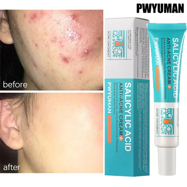 Acne Repair Face Cream