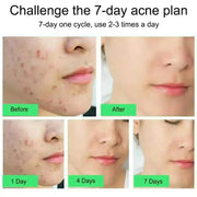 Acne Repair Face Cream